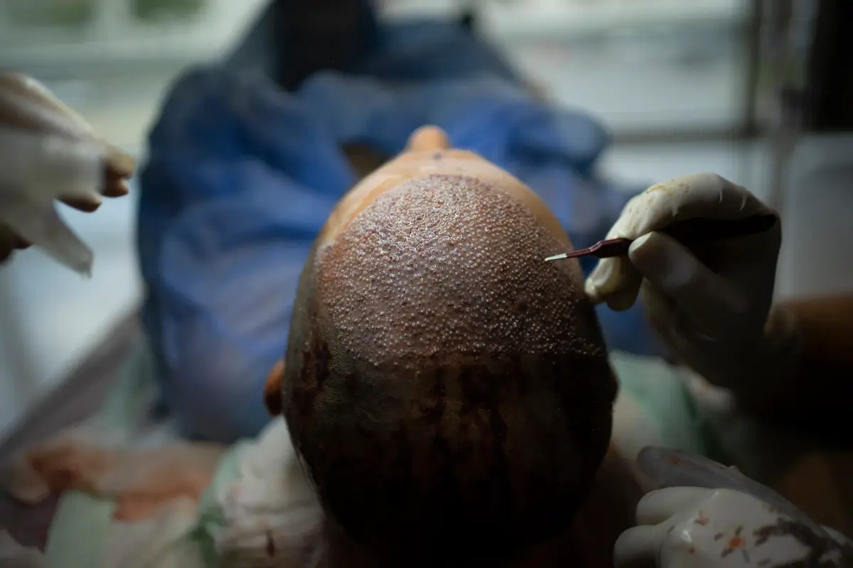 كيف أصبحت إسطنبول عاصمة زراعة الشعر في العالم